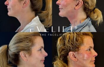 female patient before and after EVELIFT®