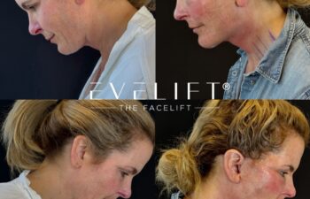 female patient before and after EVELIFT®
