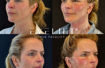 female patient before and after EVELIFT®