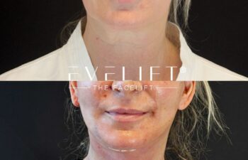 female patient before and after EVELIFT®