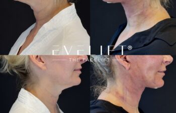 female patient before and after EVELIFT®