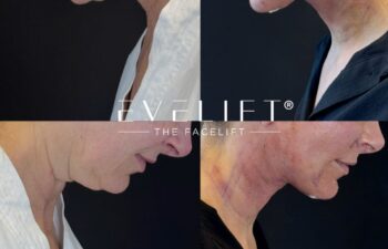 female patient before and after EVELIFT®