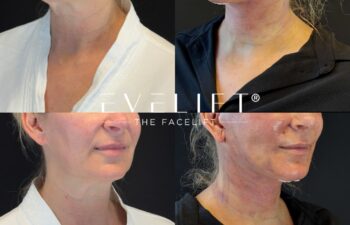 female patient before and after EVELIFT®