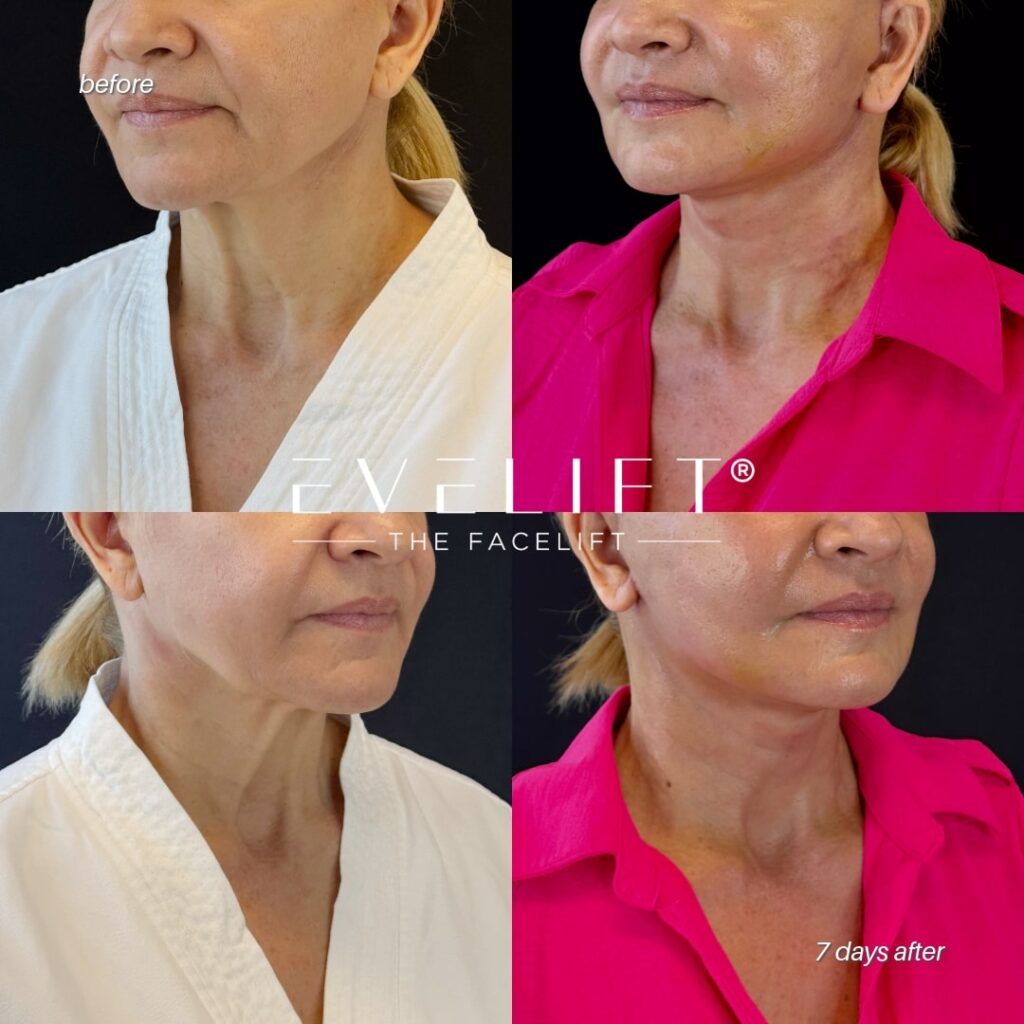 female patient before and after EVELIFT®