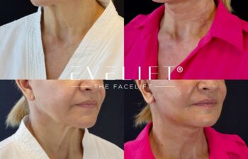 female patient before and after EVELIFT®