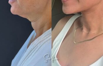 female patient before and after EVELIFT®