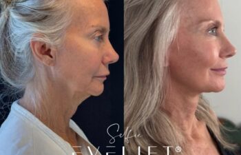 female patient before and after EVELIFT®