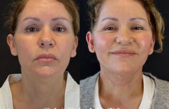 female patient before and after EVELIFT®