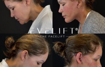 female patient before and after EVELIFT®
