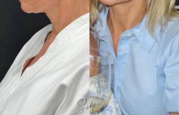 female patient before and after EVELIFT®