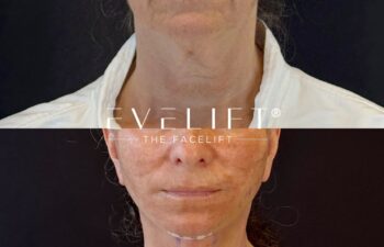 female patient before and after EVELIFT®