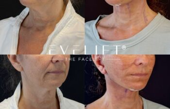female patient before and after EVELIFT®