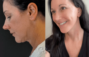 female patient before and after EVELIFT®