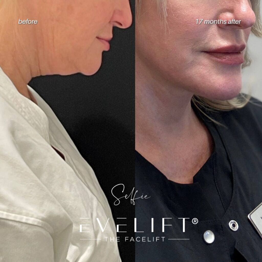 female patient before and after EVELIFT®