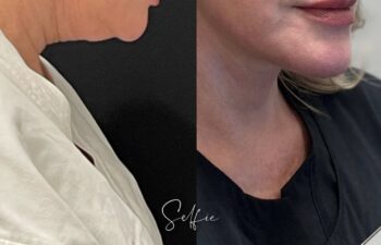 female patient before and after EVELIFT®