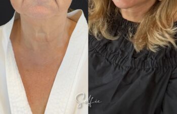 female patient before and after EVELIFT®