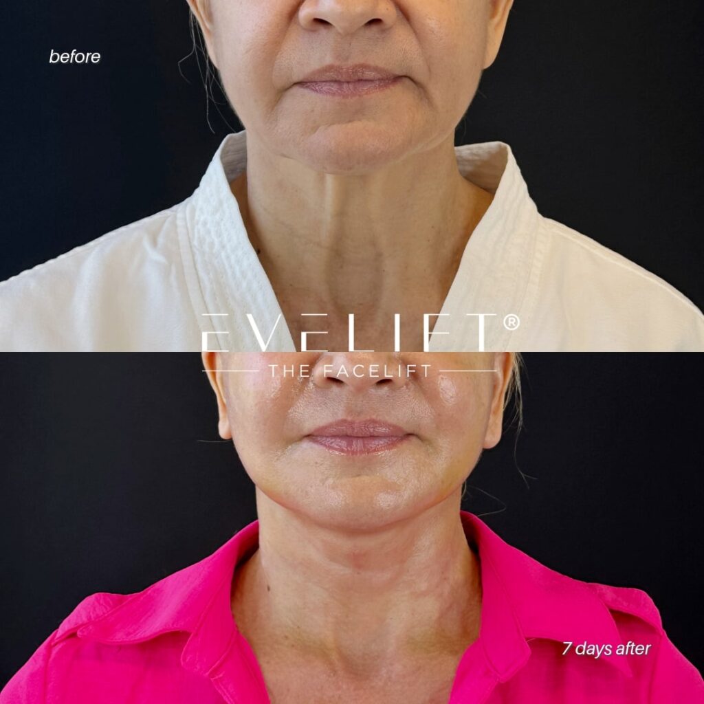 female patient before and after EVELIFT®