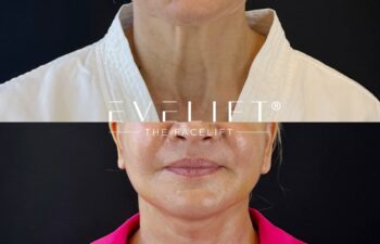 female patient before and after EVELIFT®
