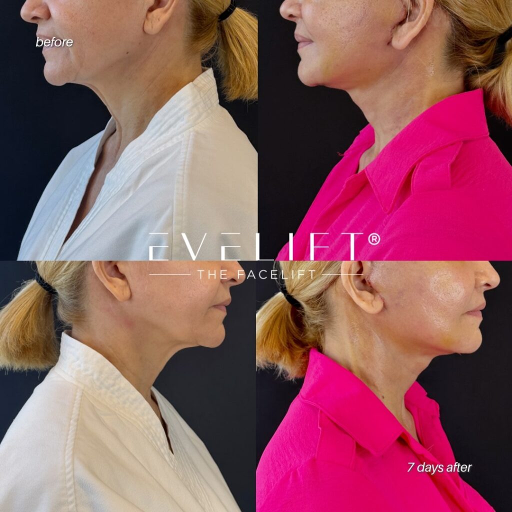 female patient before and after EVELIFT®