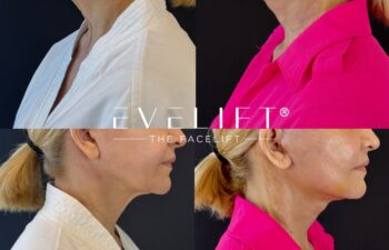 female patient before and after EVELIFT®
