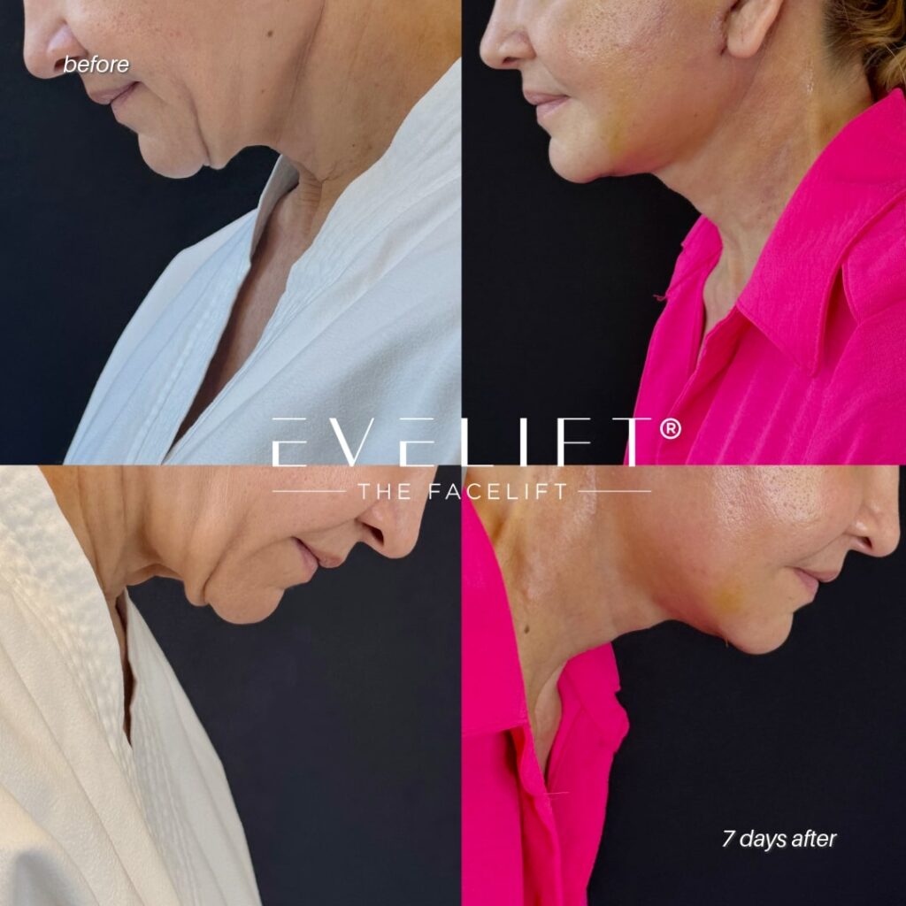 female patient before and after EVELIFT®