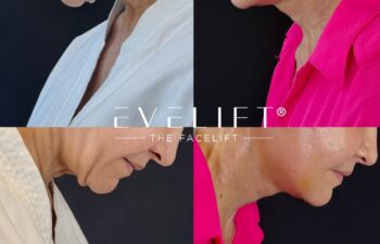 female patient before and after EVELIFT®