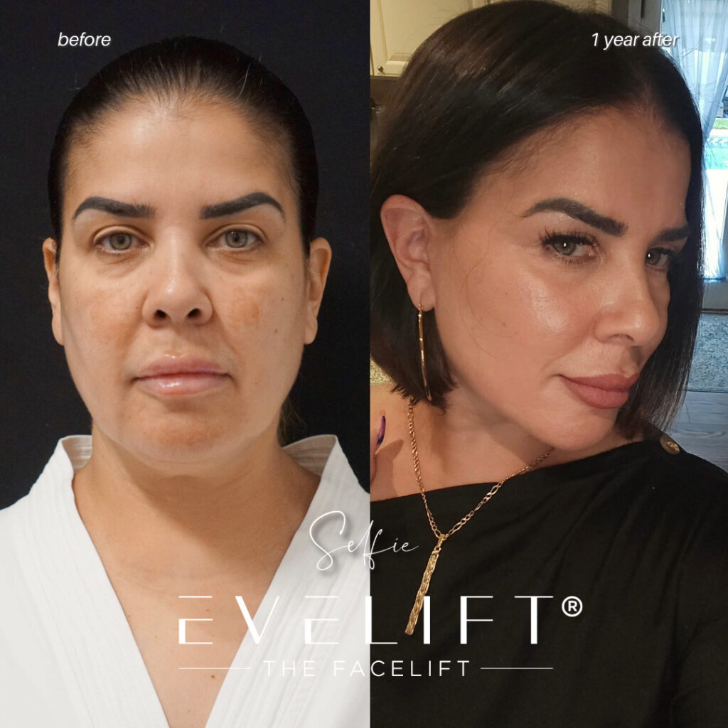 female patient before and after EVELIFT®