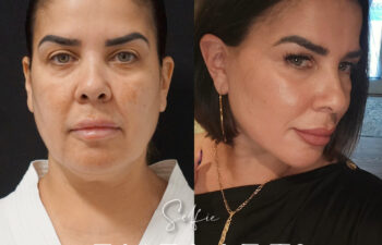 female patient before and after EVELIFT®