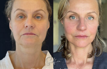 female patient before and after EVELIFT®