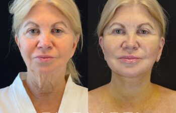 female patient before and after EVELIFT®