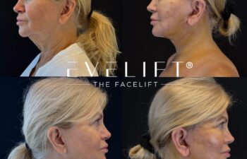 female patient before and after EVELIFT®