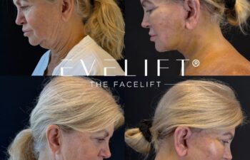 female patient before and after EVELIFT®