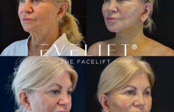 female patient before and after EVELIFT®