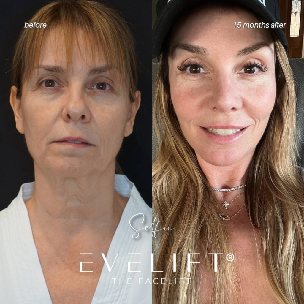 female patient before and after EVELIFT®