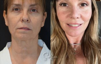 female patient before and after EVELIFT®