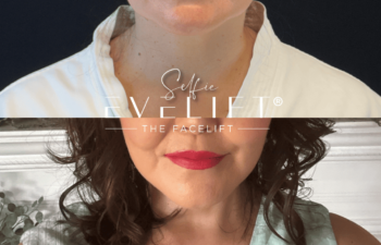 female patient before and after EVELIFT®