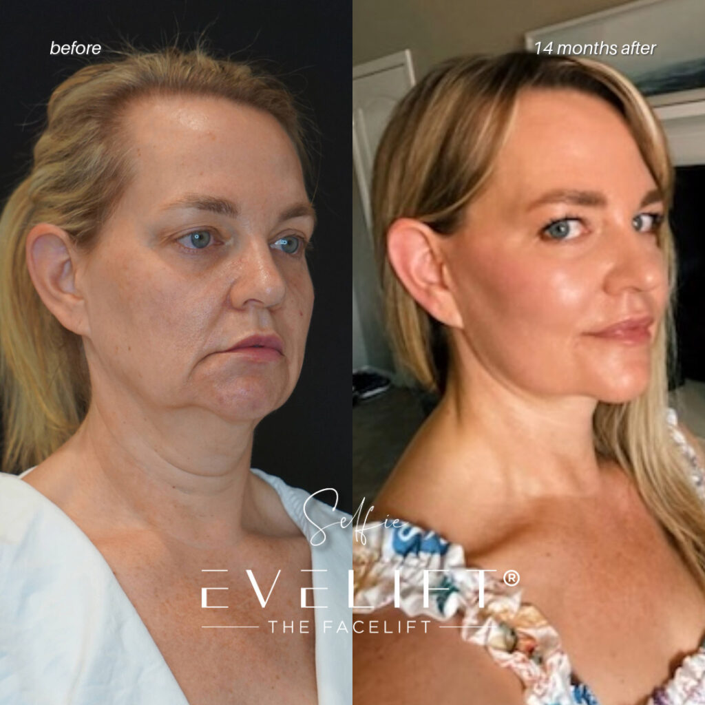 female patient before and after EVELIFT®