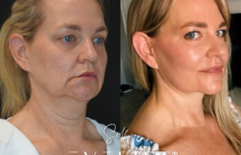 female patient before and after EVELIFT®