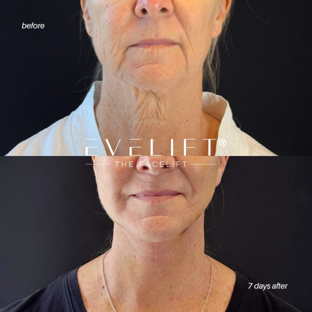 female patient before and after EVELIFT®