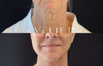 female patient before and after EVELIFT®