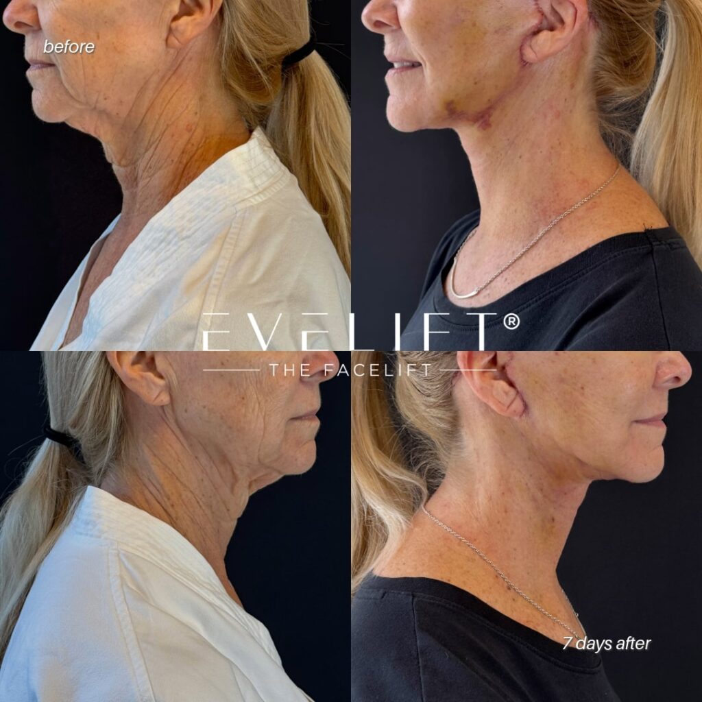 female patient before and after EVELIFT®