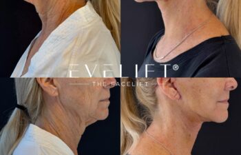 female patient before and after EVELIFT®
