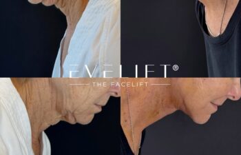 female patient before and after EVELIFT®