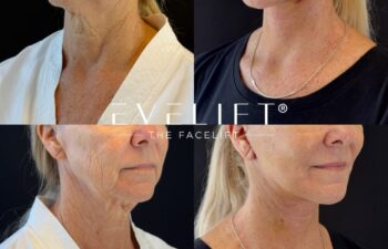 female patient before and after EVELIFT®