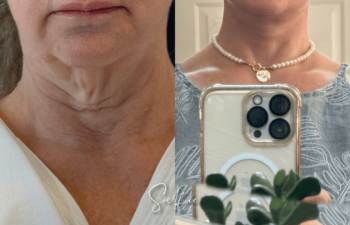 female patient before and after EVELIFT®