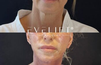 female patient before and after EVELIFT®