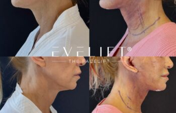 female patient before and after EVELIFT®