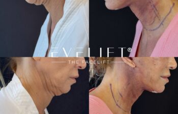 female patient before and after EVELIFT®