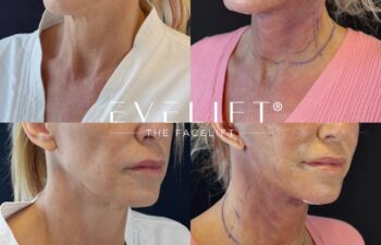 female patient before and after EVELIFT®