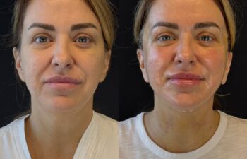 female patient before and after EVELIFT®